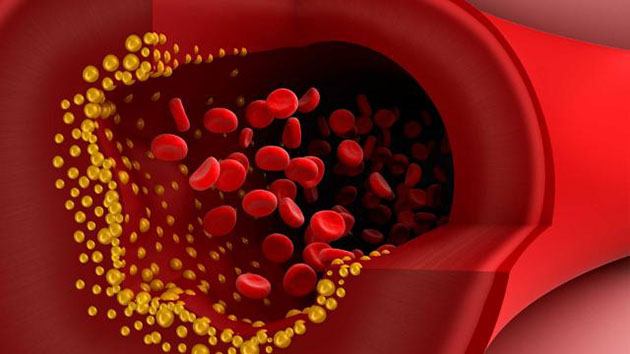 Cholesterol tạo nên mảng bám trên thành mạch máu gây nguy hiểm cho sức khỏe
