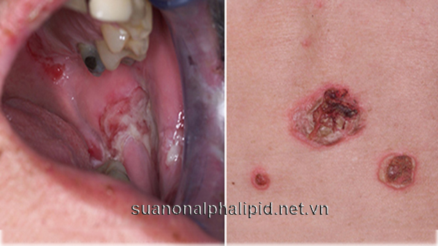 Pemphigus gây viêm loét miệng