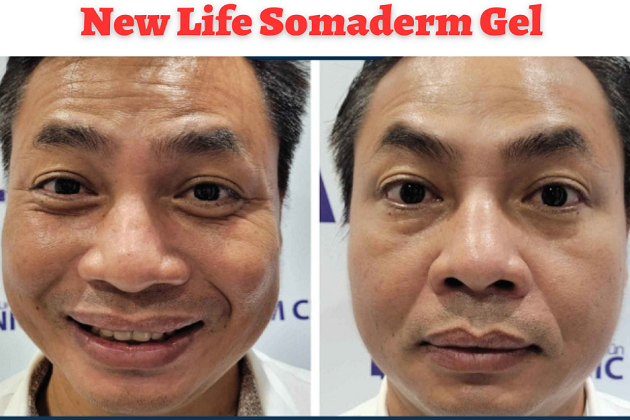 review somaderm 3